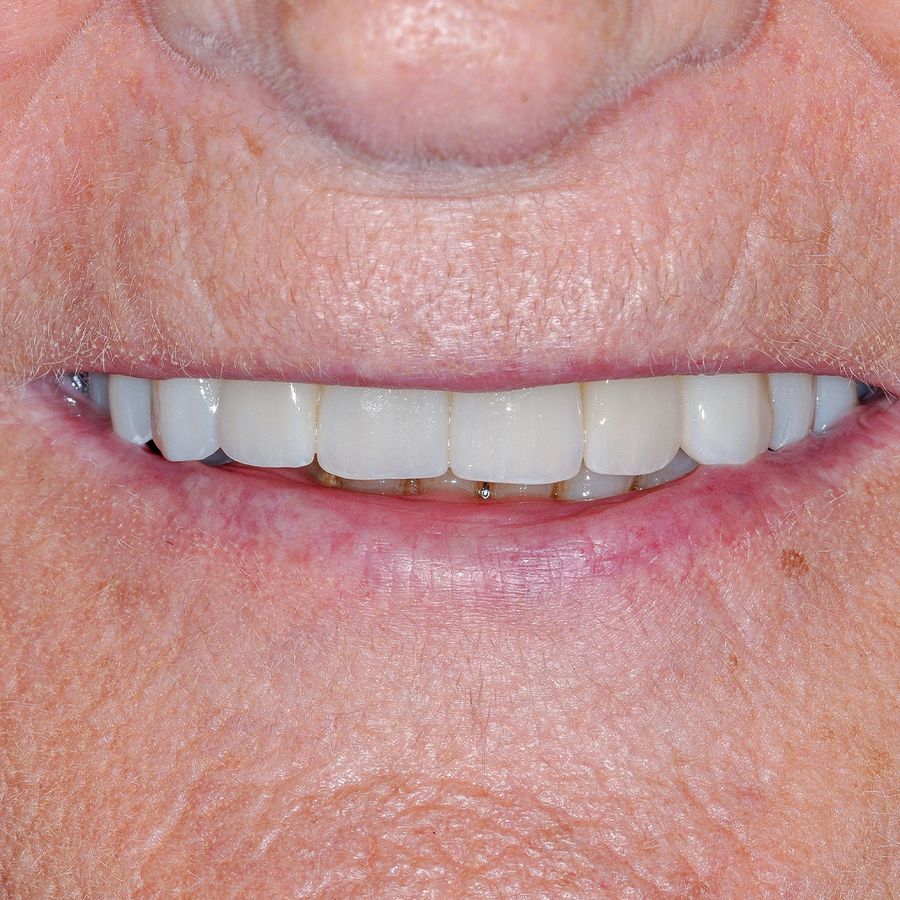 Dental Implants Crowns After